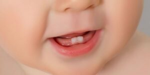 Image of infants mouth with two new teeth showing on the bottom gums