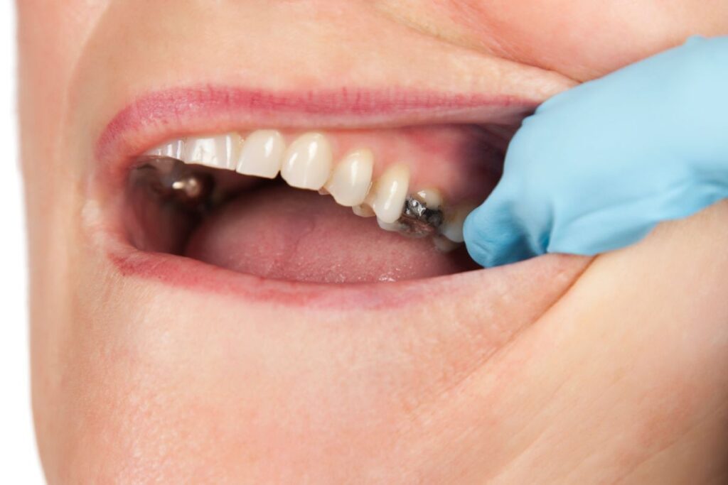 Image of dentist working on patient teeth