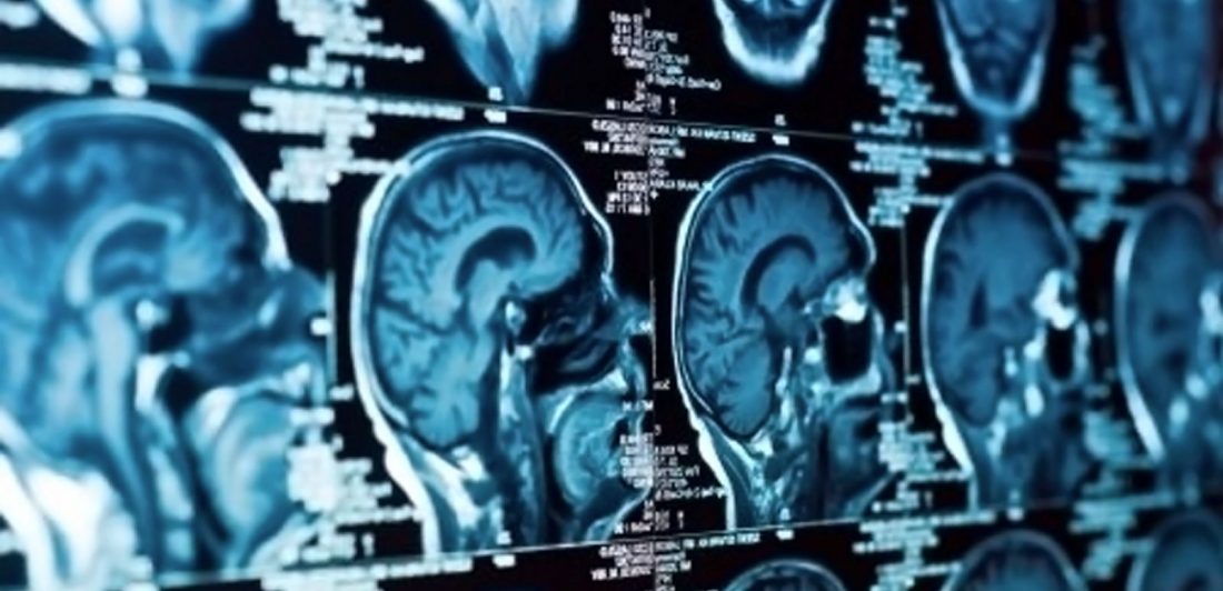 Image of brain scan film